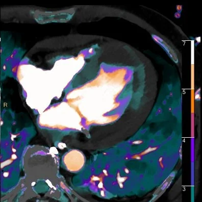 Fused iodine map, early scan: LV apical clot and inferolateral hypoperfusion.