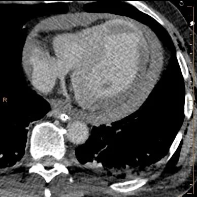 Conventional delayed scan. This is key in making the diagnosis.