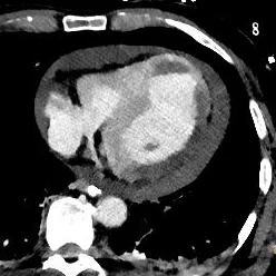 Delayed image, 40 keV image. Iodine is a lot brighter, so the clot and MI are both much more obvious.
