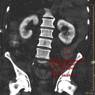 Iodine map: Clear iodine uptake in ascitic fluid.