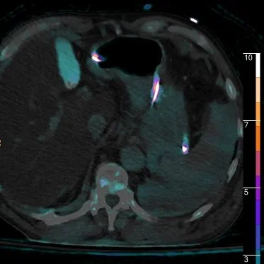 Fused axial image with iodine overlay shows iodine uptake in perisplenic fluid, and excretion in the gallbladder.