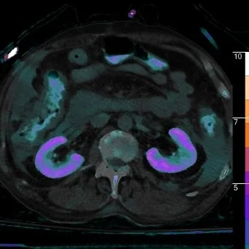 Fused axial image with iodine overlay shows iodine uptake in pericolonic fluid, as well as iodine excretion in the colon (this may be from biliary excretion or direct GI excretion of contrast).