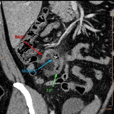 Conventional CT: Note obviously inflammed mid-appendix with small lith.