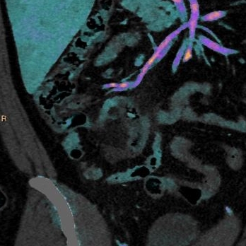 Does this appendix come out?