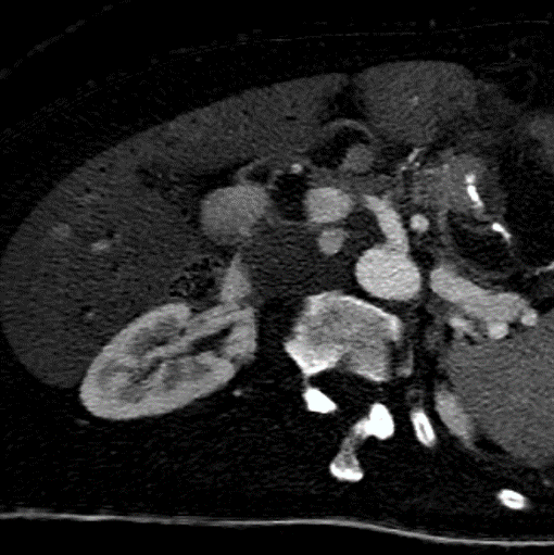 Oblique axial iodine map: Note intense uptake in the gastric submucosal nodule and the porta hepatis mass.