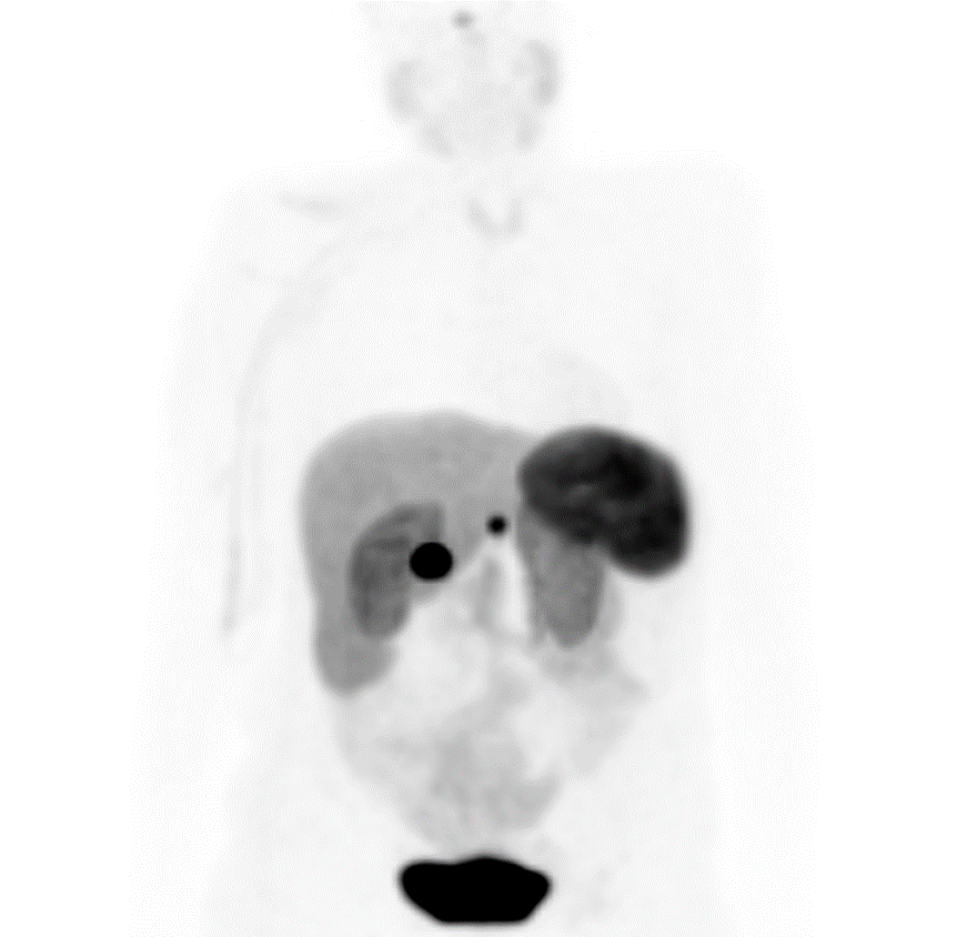 Gallium Dotatate PET scan: uptake in gastric submucosal nodule and the porta hepatis mass confirms neuroendocrine nature. Physiologic uptake in pituitary, spleen and liver.