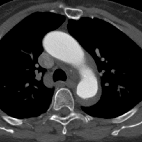 Conventional CT: thickened wall of the descending aorta