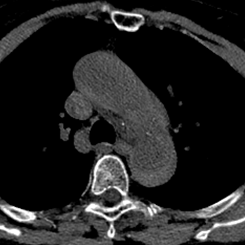 Virtual non-contrast: The wall thickening has increased attenuation, diagnostic of an intramural hematoma.