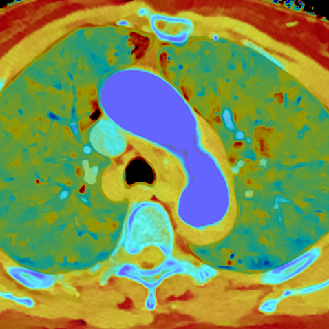Intramural hematoma