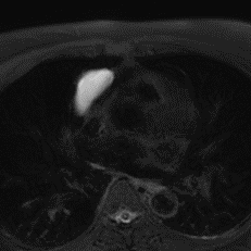 Non-contrast MR (T2-weighted with fat sat): It is indeed a simple cyst!