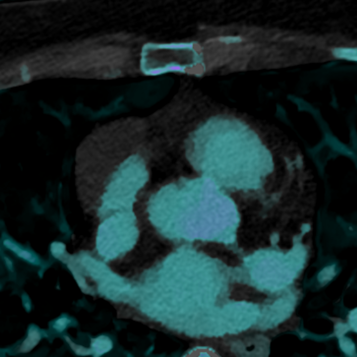Mediastinal mass