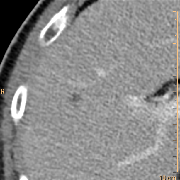 Conventional CT: Notice tiny liver lesion.