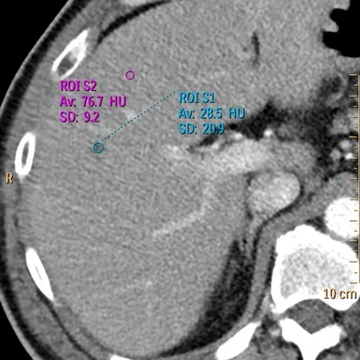Conventional CT: At 28.5 HU, this lesion is "too small to characterize".
