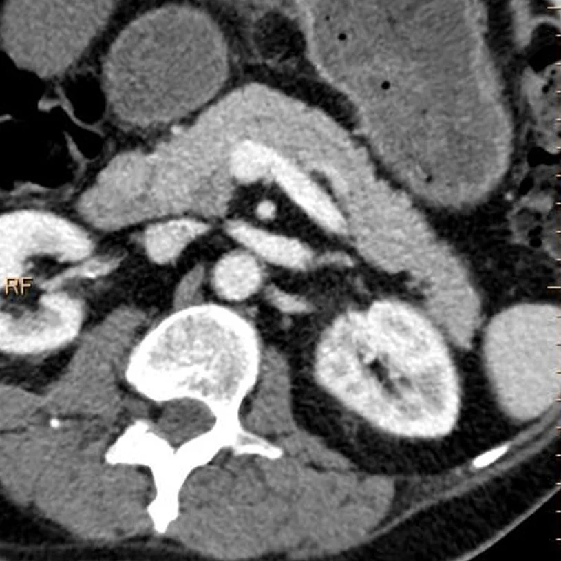Conventional CT, axial oblique. Is there a lesion in the pancreas?