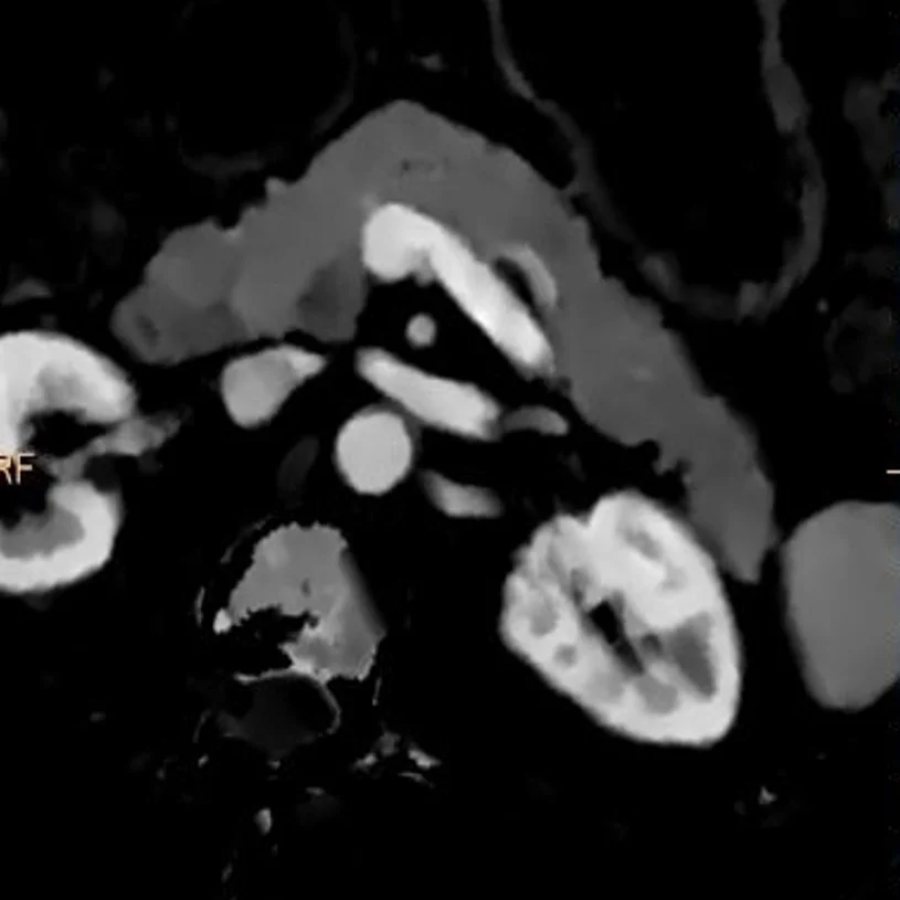 Iodine map, axial oblique: Lesion is easy to see! Hypoenhancement is characteristic of pancreatic adenocarcinomas.