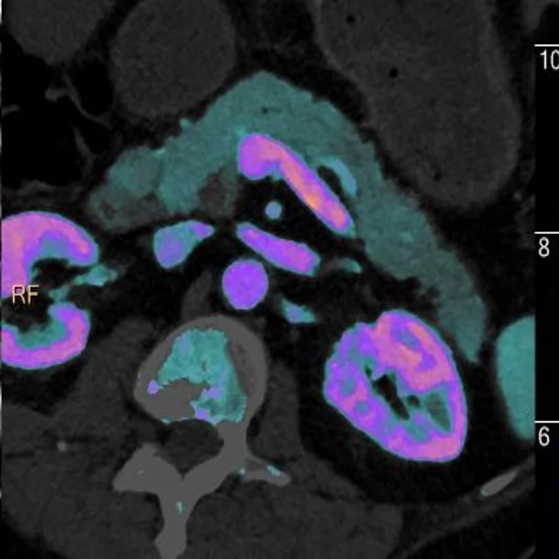 Iodine overlay image, axial oblique: Just showing off.