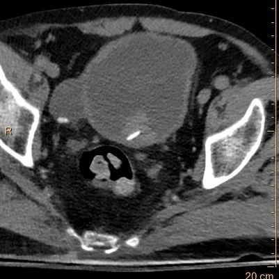 Virtual non-contrast: The filling defect is hyperdense.