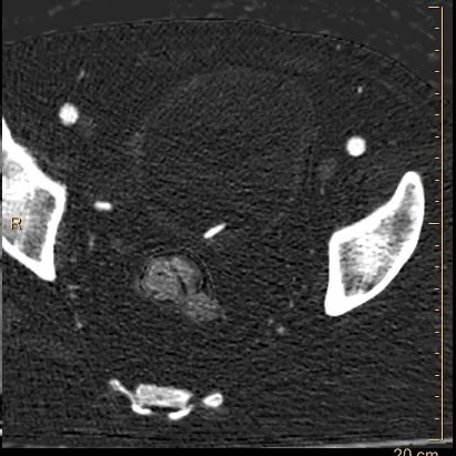 Iodine map: No iodine uptake in filling defect. This is a clot around a bladder stone.