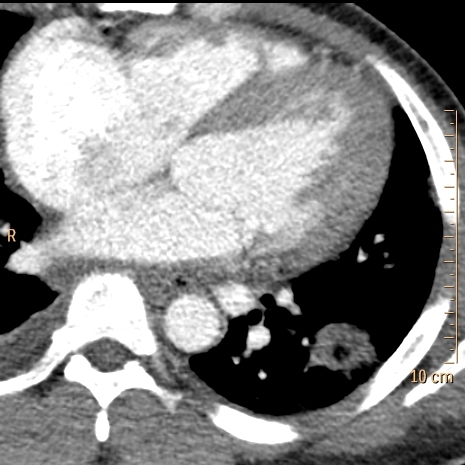 Conventional CT: Cavitary nodule in left lower lobe. Nothing particularly interesting in the heart.