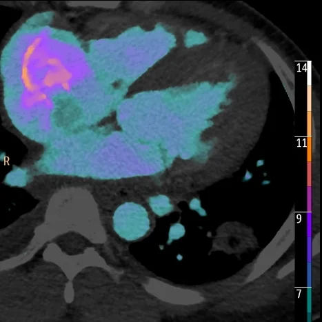 Endocarditis