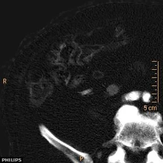 Iodine map shows clear iodine uptake, consistent with tumor.