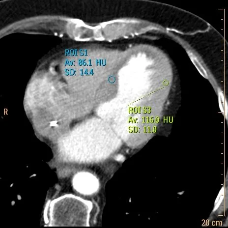 Conventional CT: The septum shows slightly decreased attenuation, but hard to pick up from the noise