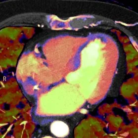 Myocardial ischemia at rest