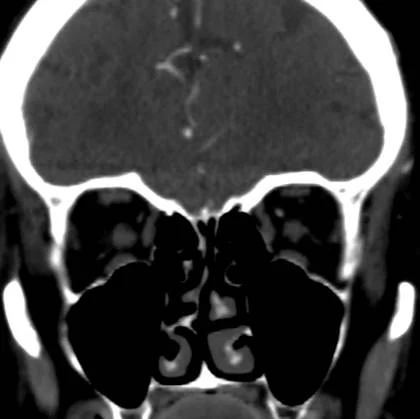 Conventional CT, coronal plane. The optic nerves are unremarkable.