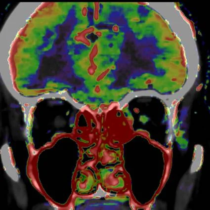 Optic nerve perfusion in CRAO