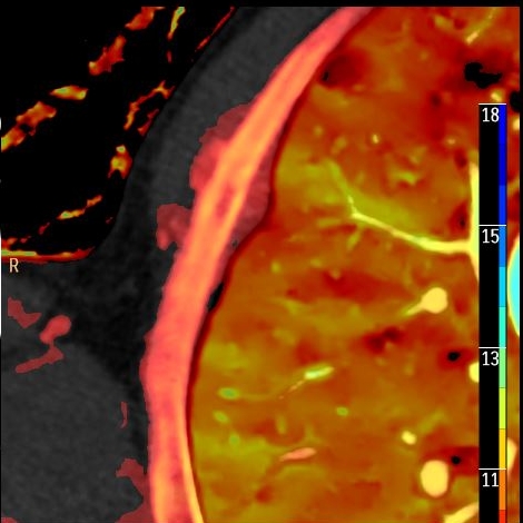 The pleura, is it visible?