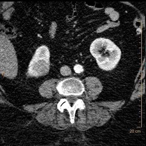 Conventional CT: Do you see the lesion in lower pole of the right kidney?