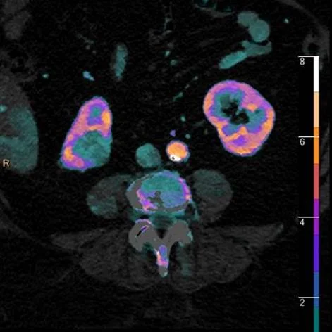 Lesion nicely depicted on iodine overlay