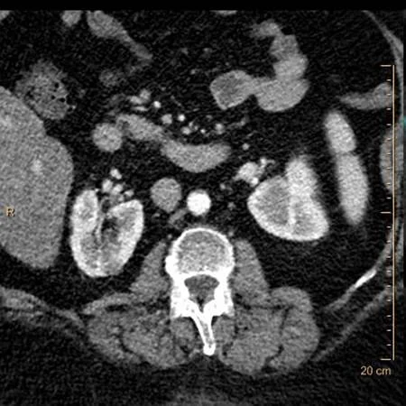 Conventional CT: Do you see the lesion in upper pole of the right kidney?