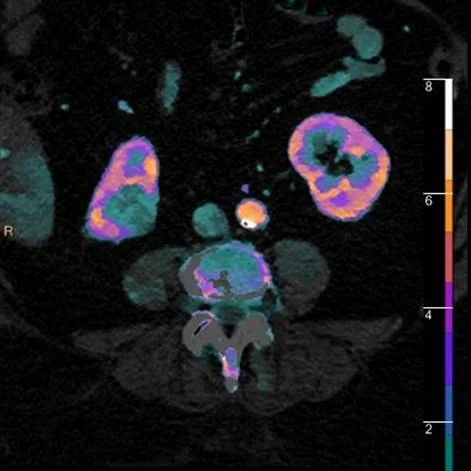 Spectral CT: Like DWI, with CT