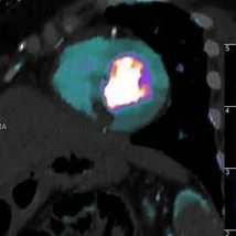 Perfusion defect shown very nicely on iodine overlay. Note how well it corresponds to the delayed enhancement on MRI.