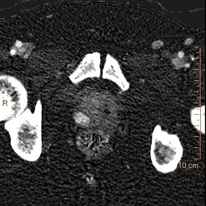 Iodine map: The right PZ nodule is a lightbulb!