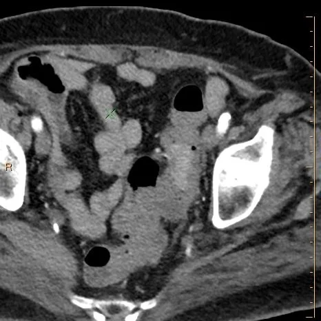 Conventional CT: Can you really see the mass?