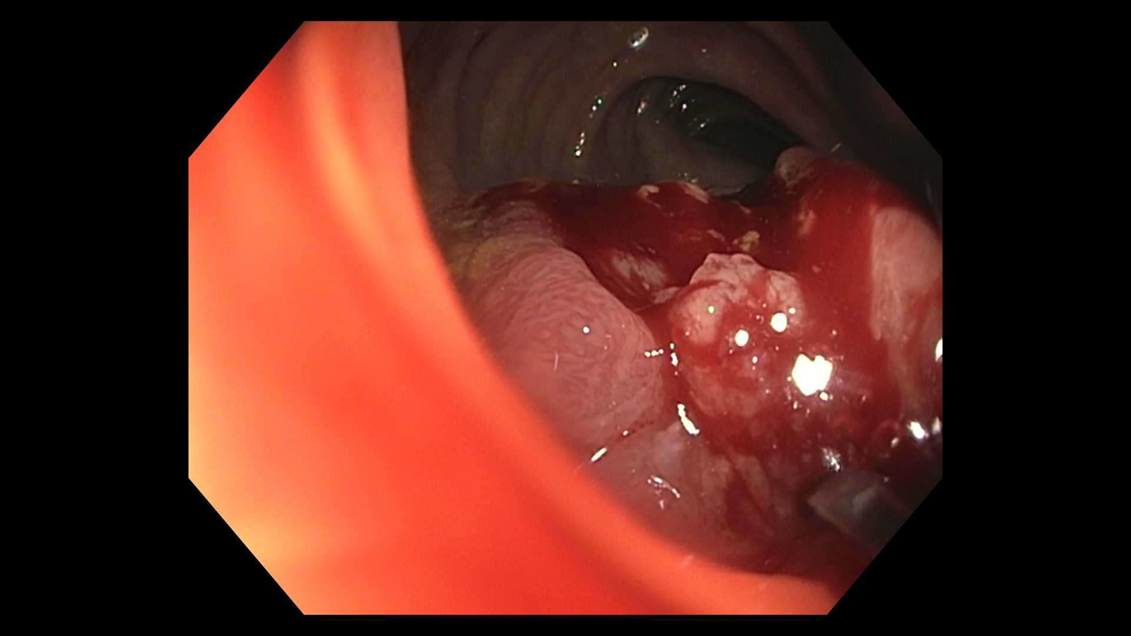 Mass as seen on colonoscopy. This is a moderately differentiated adenocarcinoma.