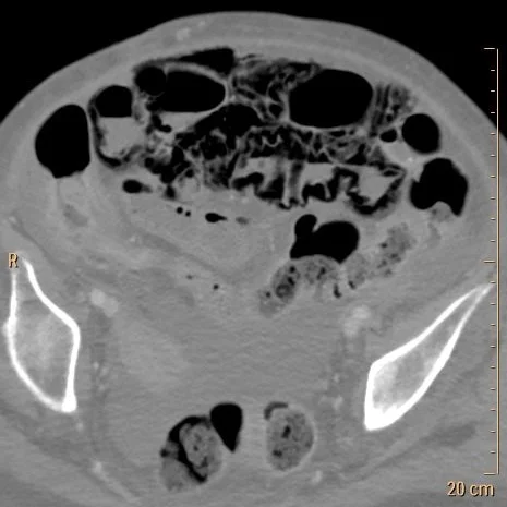Conventional CT: Extensive pnematosis.
