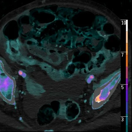 Iodine overlay: Nicely depicts perfusion to these loops.