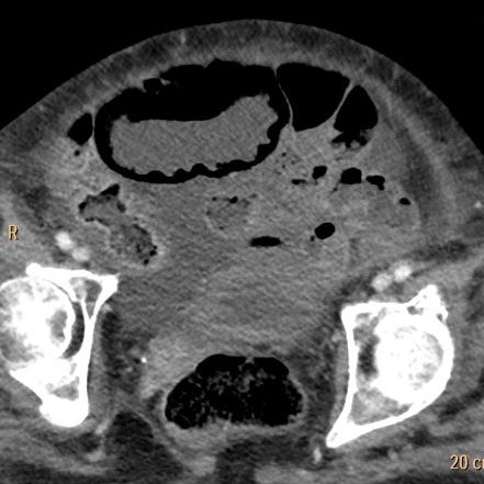 Conventional CT: Note pnematosis in the dilate loop anteriorly.
