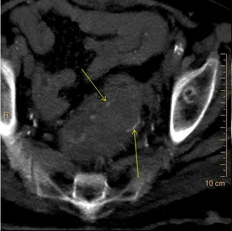 Virtual non-contrast: The “hyperdensity” is gone! So you do not really need a true non-contrast exam. The yellow arrows show the anastomosis.