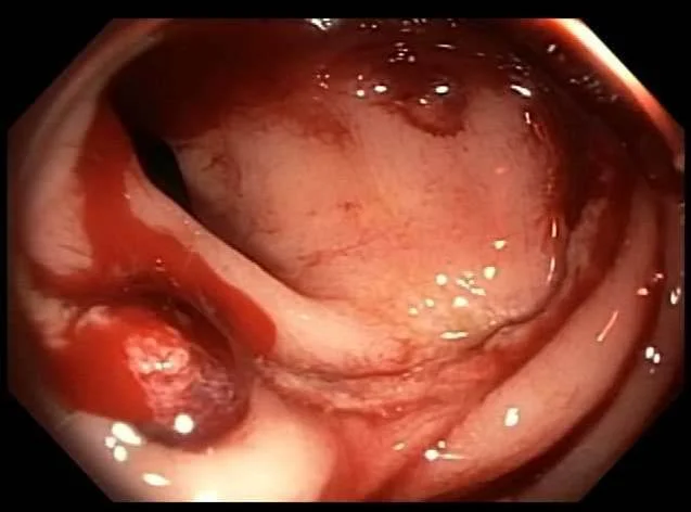 Bleeding vessel seen on flexible sigmoidoscopy