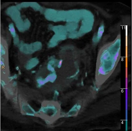 A case of rectal bleeding