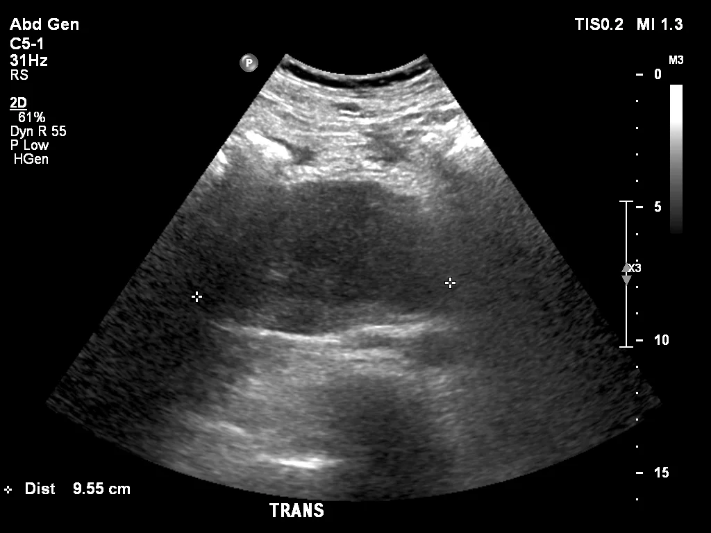 Ultrasound shows large “collection”