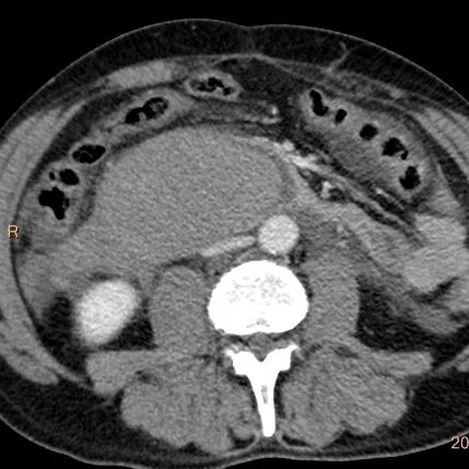 Conventional CT: large doudenal “mass”. This corresponds to the “collection” seen on ultrasound.