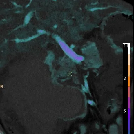 Duodenal hematoma