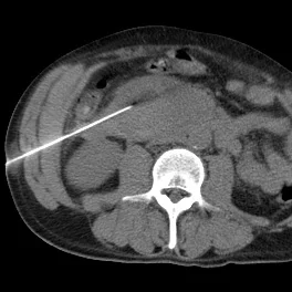 Percutaneous drainage of the doudenal hematoma.