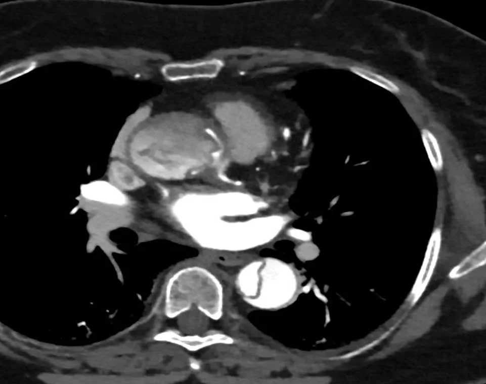 Conventional CT, arterial phase shows Stanford type A dissection involving ostium of the left main coronary artery.