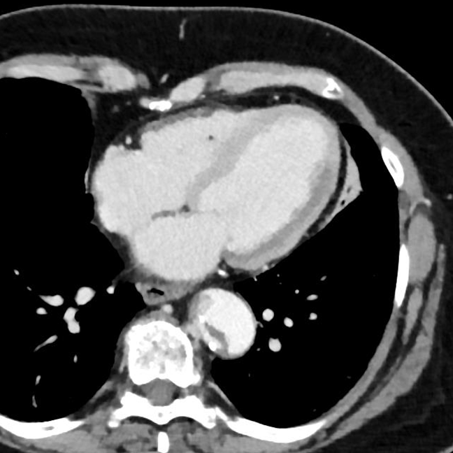 Conventional CT, venous phase. You might pick up hypoperfusion in lateral wall of left ventricle on a good day, but then again…